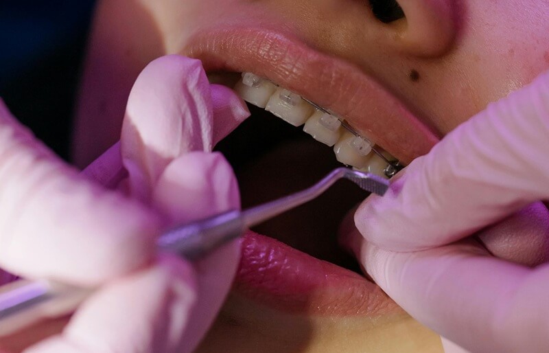 Braces & Aligners